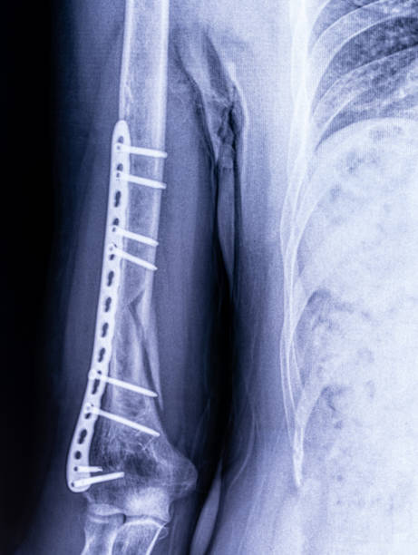 imagen de rayos x osteosíntesis de una fractura de húmero - human artery audio fotografías e imágenes de stock