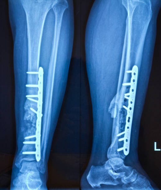 radiographie de la jambe avec cheville. - x ray human knee orthopedic equipment human bone photos et images de collection