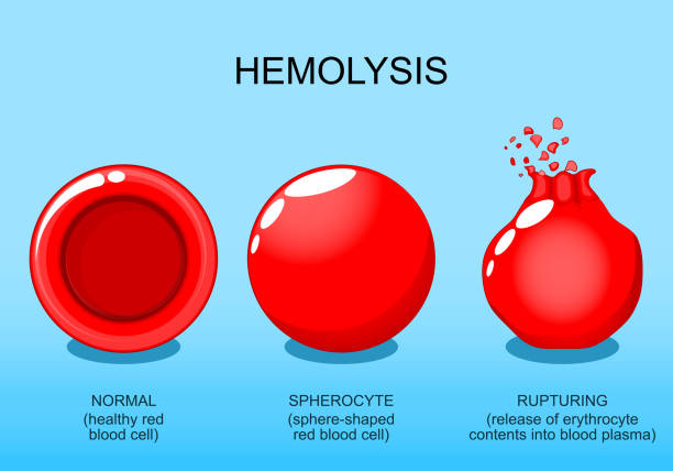 용혈. 정상적인 적혈구, 구상세포, 적혈구 파열. - blood cell anemia cell structure red blood cell stock illustrations