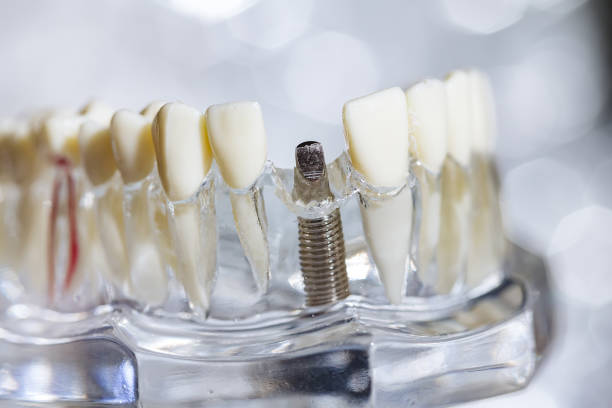istock Dental tooth implant titanium prosthetic dentists model. 2008339762