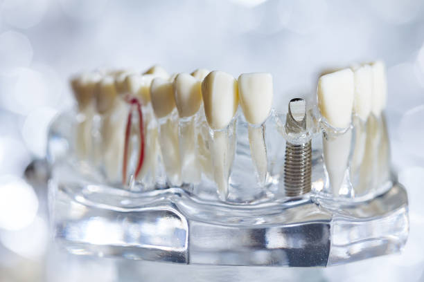 istock Dental tooth implant titanium prosthetic dentists model. 2008339780