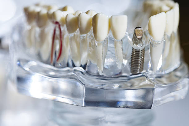 istock Dental tooth implant titanium prosthetic dentists model. 2008339783