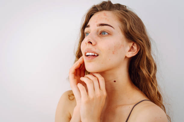 istock Young woman with problem skin. Life with acne. 2009894178