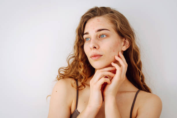 istock Young woman with problem skin. Life with acne. 2009894179