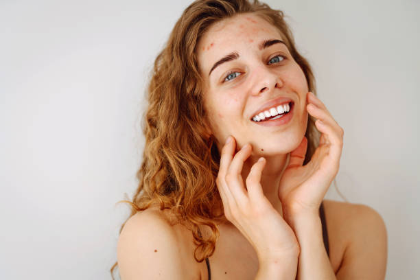 istock Young woman with problem skin. Life with acne. 2009894181