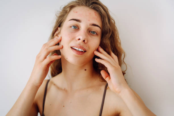 istock Young woman with problem skin. Life with acne. 2009894691