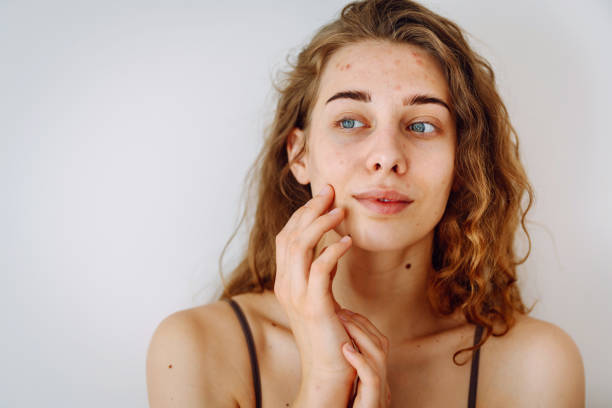 istock Young woman with problem skin. Life with acne. 2009894692