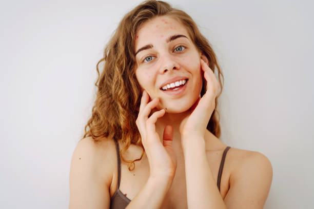 istock Young woman with problem skin. Life with acne. 2009894710