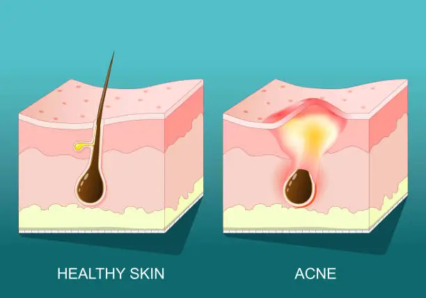 Vector illustration of Acne. Cross section of a human skin with pimple