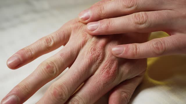 A man examines his dry, cracked skin on his hand close-up
