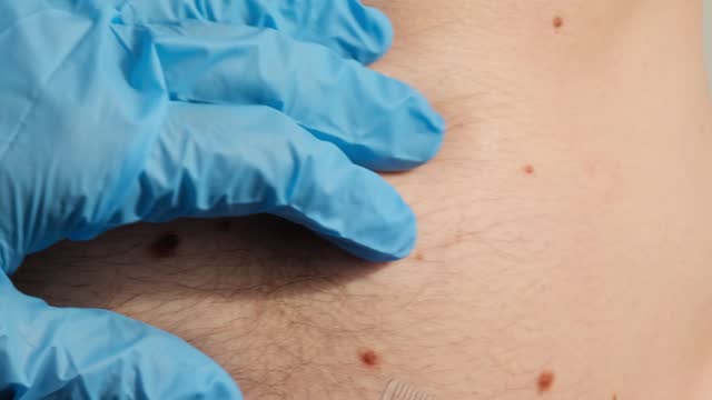 Dermatologist checking male birthmarks with ruler. Doctor examining length and width of benign moles on man skin