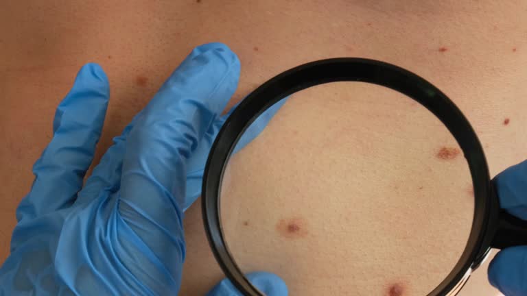 Mole dermoscopy, preventive of melanoma. Dermatologist examining patient's birthmark with magnifying glass in clinic. Checking benign moles. Skin abnormalities care