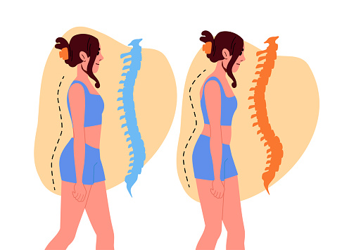 Scoliosis in girl concept. Woman with problems with pisture. Health care and medicine, treatment. Correction of posture. Cartoon flat vector illustration isolated on white background