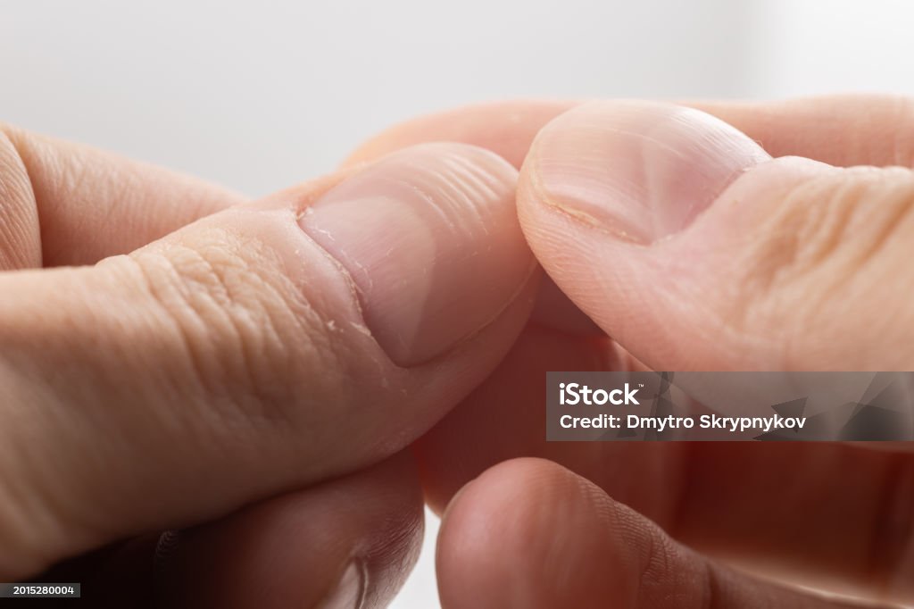 Nails Getting Ridges Ridged Fingernails With Vertical And Horizontal Ridges Nails Problems ...