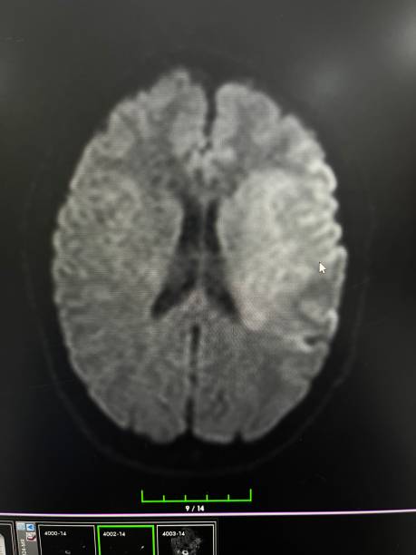 um paciente de 38 anos que se queixou de fraqueza no lado direito e fez uma ressonância magnética de difusão cerebral mostrando infarto da acm esquerda estará em konya, na turquia, em 2024. - corpus striatum - fotografias e filmes do acervo