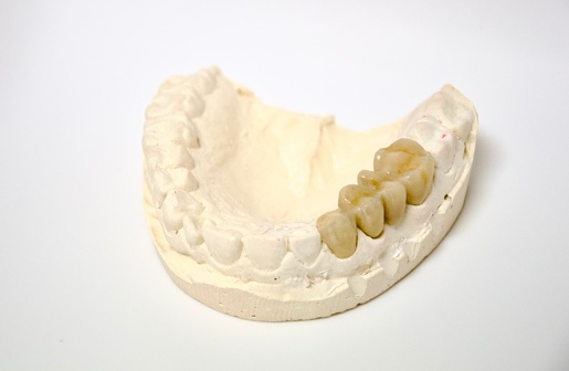 Dental bridge on plaster dental arch, dentistry prosthesis, teeth implant over molar and premolar