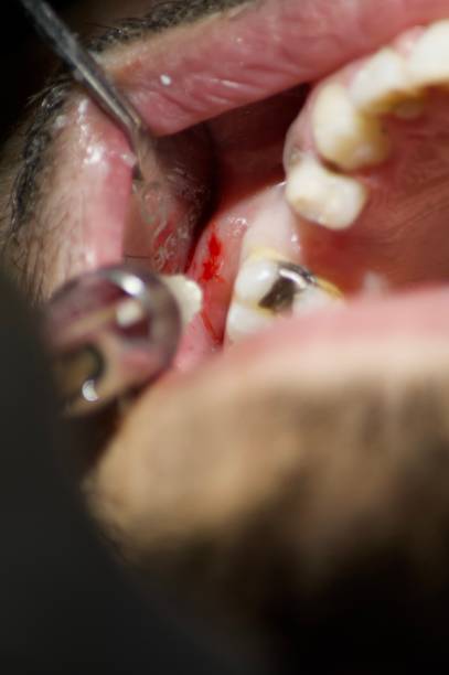 istock Patient get anesthesia in the mouth by the dentist 2017585139