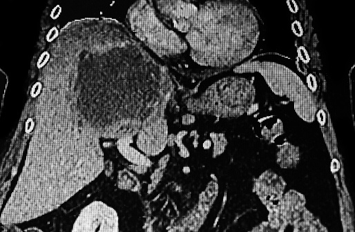 Cat Scan of amoebic liver abscess. Medical themes