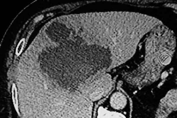 istock Cat Scan of amoebic liver abscess. 2018310909