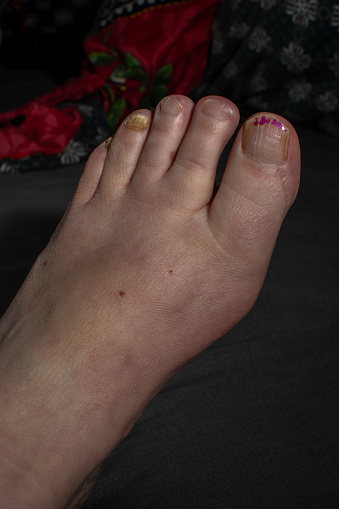 photo of a foot with fungal nails, leftover nail polish on the big toe