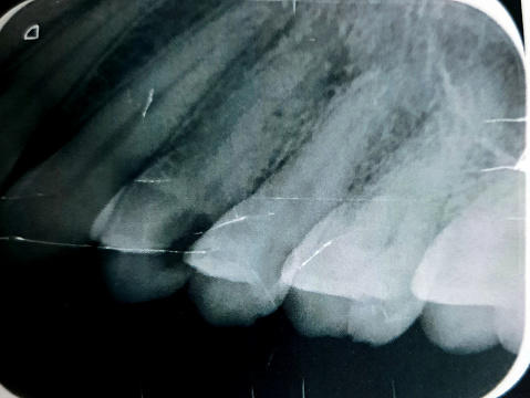 X ray reveals dental inflammation, abscess, a collection of pus that can form inside the teeth, in the gums, or in the bone that holds the teeth in place caused by bacterial infection, selective focus