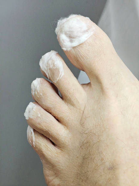 Toes covered with soaked cotton