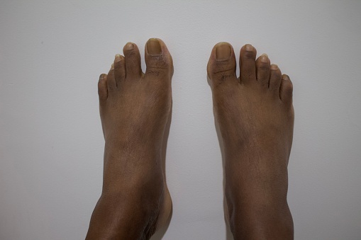 This is a picture of a black man's feet with dry skin and fungal on his nails