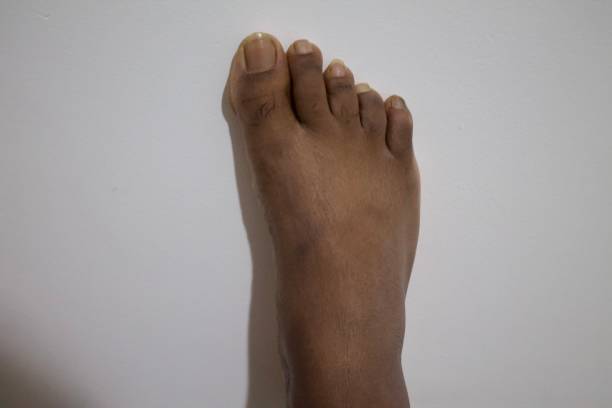 A black man's foot with injured big nails