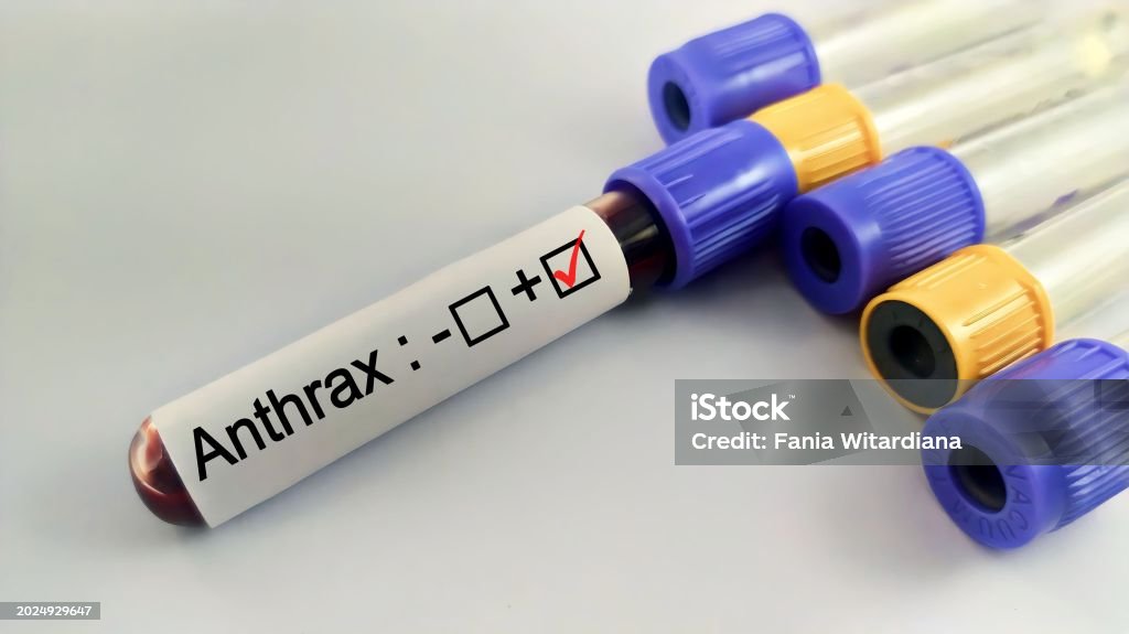 Anthrax Lab Testing Blood Sample Positive With Anthrax Bacteria Stock Photo - Download ...