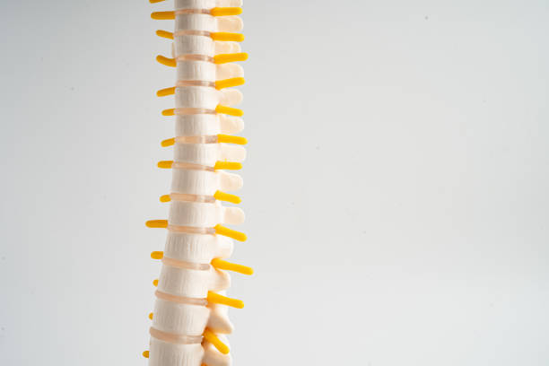 lumbar spine displaced herniated disc fragment, spinal nerve and bone. model for treatment medical in the orthopedic department. - slipped disc fotografías e imágenes de stock