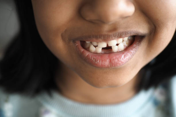 istock detail shot of child with teeth missing 2025033305