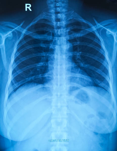 istock X-ray of the human Chest.  Right-sided rudimentary cervical rib. 2025499271