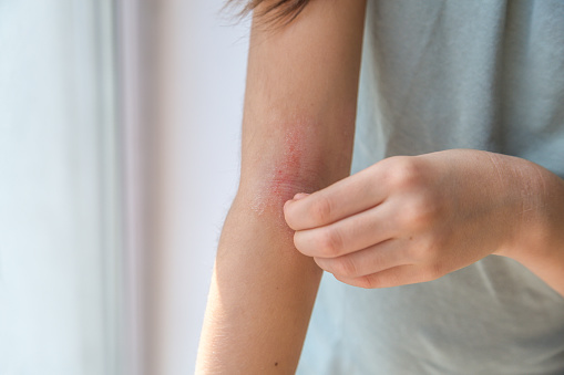 a girl scratches the skin on the elbow of her arm, redness is atopic dermatitis, the girl s face is not visible.