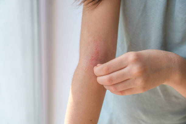 a girl scratches the skin on the elbow of her arm, redness is atopic dermatitis, the girl s face is not visible a girl scratches the skin on the elbow of her arm, redness is atopic dermatitis, the girl s face is not visible. photo psoriasis stock pictures, royalty-free photos & images