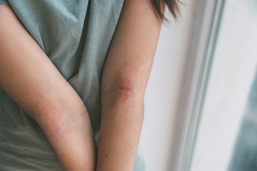 a girl shows her combed dry skin on the bend of her elbow, redness, roughness, itching from atopic dermatitis, the girl s face is not visible.