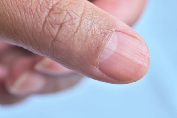 istock Lunula and longitudinal ridging nail on thumb. 2026740939