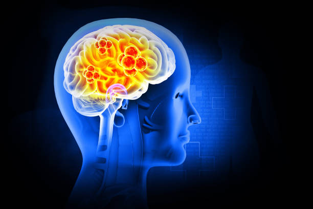 istock Brain tumor or barin cancer. 3d illustration 2027090958