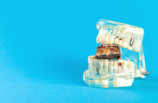 A bitten chocolate bar in a dental jaw mockup on a blue background. The concept of sweets harming tooth enamel, caries. Copy space for text, hygiene