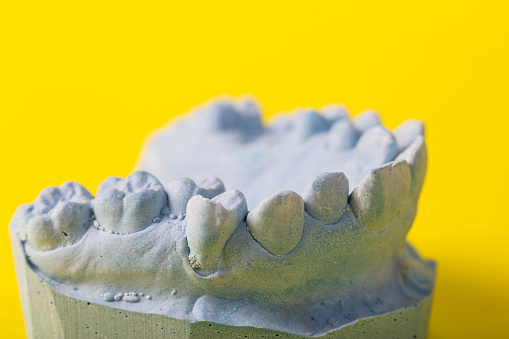 Blue plaster model of an impression of a patient's jaw at an orthodontist dentist on a yellow background. Manufacturing of dentures and crowns for dental prosthetics in orthodontics, macro. Copy space for text