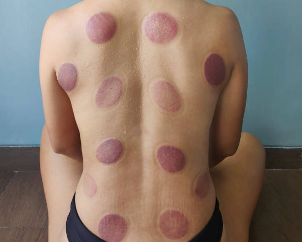 Red Cupping Mark From Cupping Therapy Close-up shot of shirtless unrecognizable person back with red cupping mark from cupping therapy. It shows a red and purple circle on the human back. cupping therapy stock pictures, royalty-free photos & images