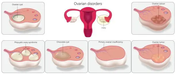 Vector illustration of Ovarian disorders vector. Female reproductive system diseases.