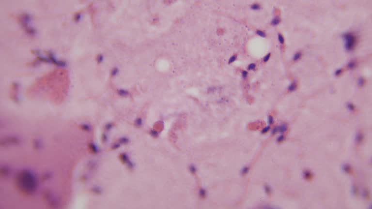 Semen. Qualitative and quantitative visual, physico-chemical and microscopic analysis of male semen (ejaculate). 1000x magnification. Oligozoospermia. Azoospermia