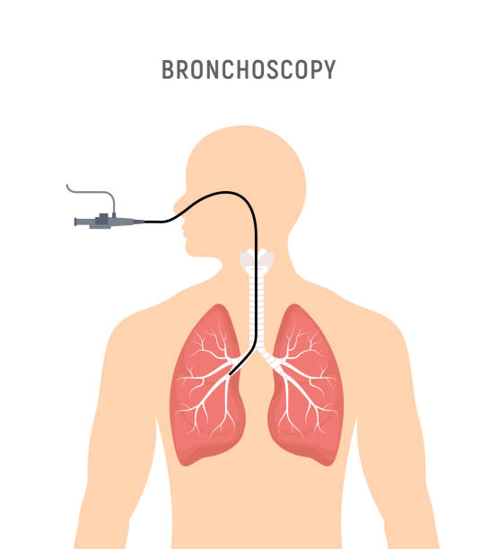 Bronchoscopy respiratory system emphysema endoscopy human lung examination. Bronchoscopy icon Bronchoscopy respiratory system emphysema endoscopy human lung examination. Bronchoscopy icon. Bronchoscopy stock illustrations