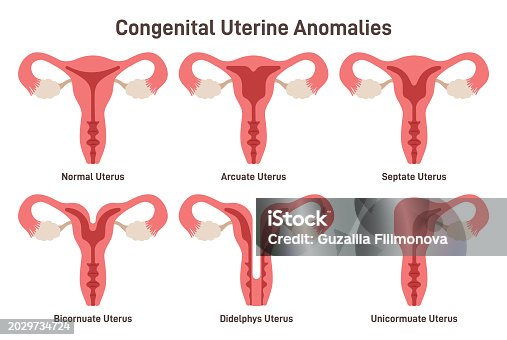 Congenital uterine anomalies set. Female reproductive system medical