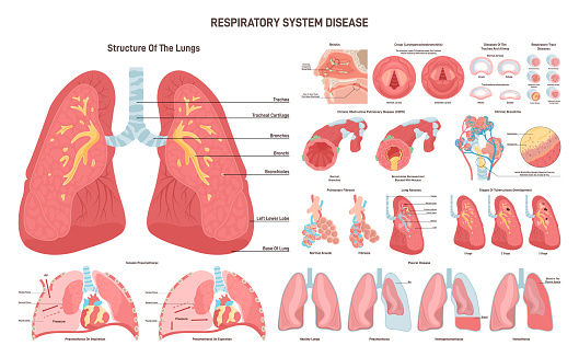 Respiratory tract diseases set. Inflammatory disease and pathological conditions of the airways. Cause of shortness of breath and cough. Medical education poster. Flat vector illustration