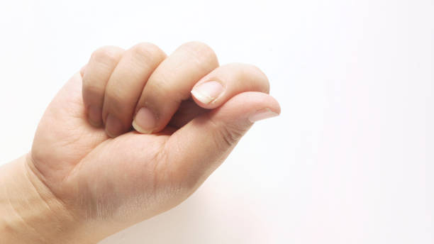 istock Hands with dry and cracked nails 2030275902
