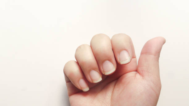 istock Hands with dry and cracked nails 2030276440