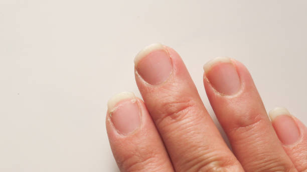 istock Hands with dry and cracked nails 2030276454