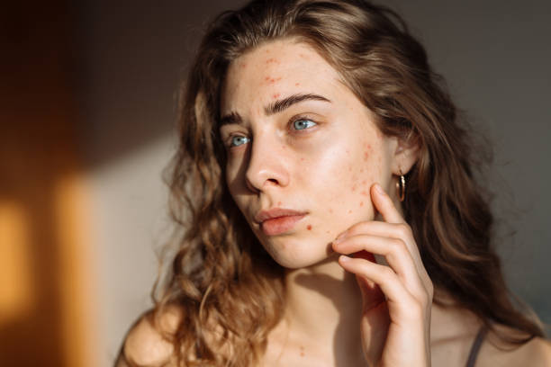istock Young Woman with a problem skin. 2030425999