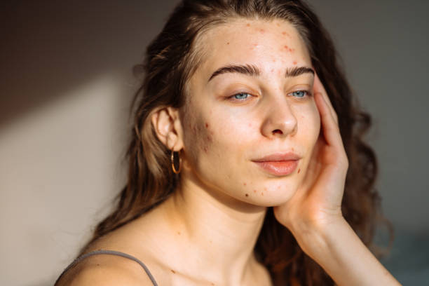 istock Young Woman with a problem skin. 2030426011